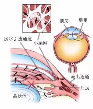 青光眼和白内障的“密切”关系