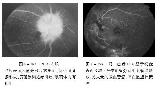 糖尿病性视网膜病变 昆明华山眼科医院