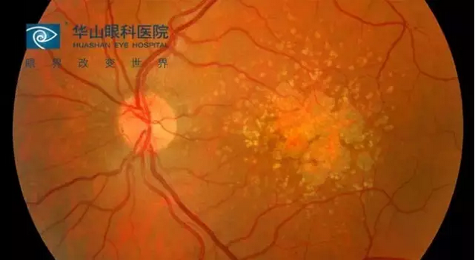 华山眼科专家：黄斑病变危害大