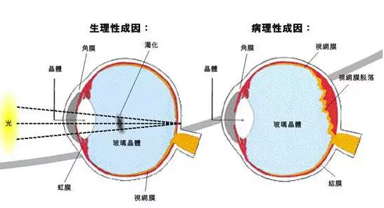 飞蚊症的由来与预防及治疗